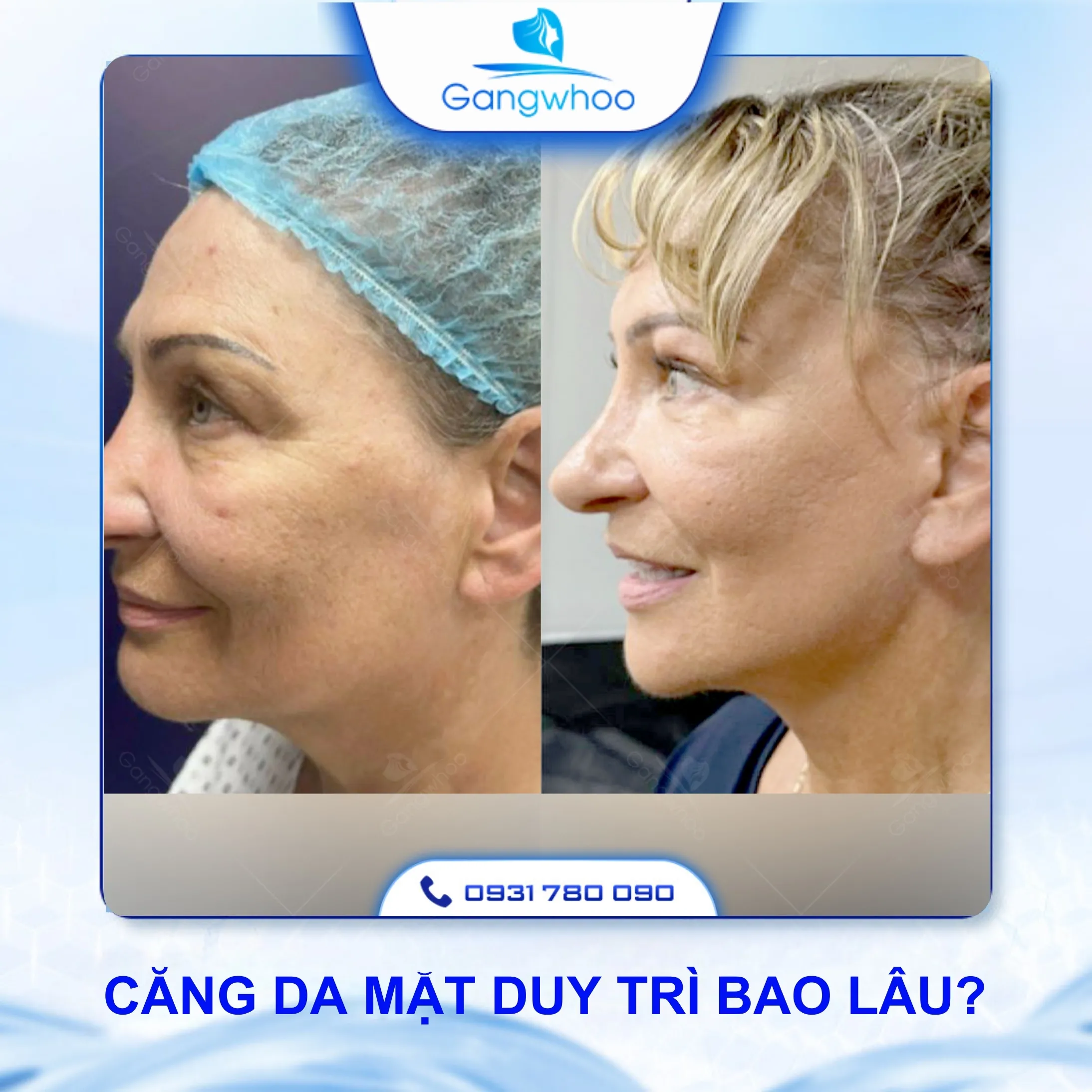 Căng Da Mặt Duy Trì Được Bao Lâu?