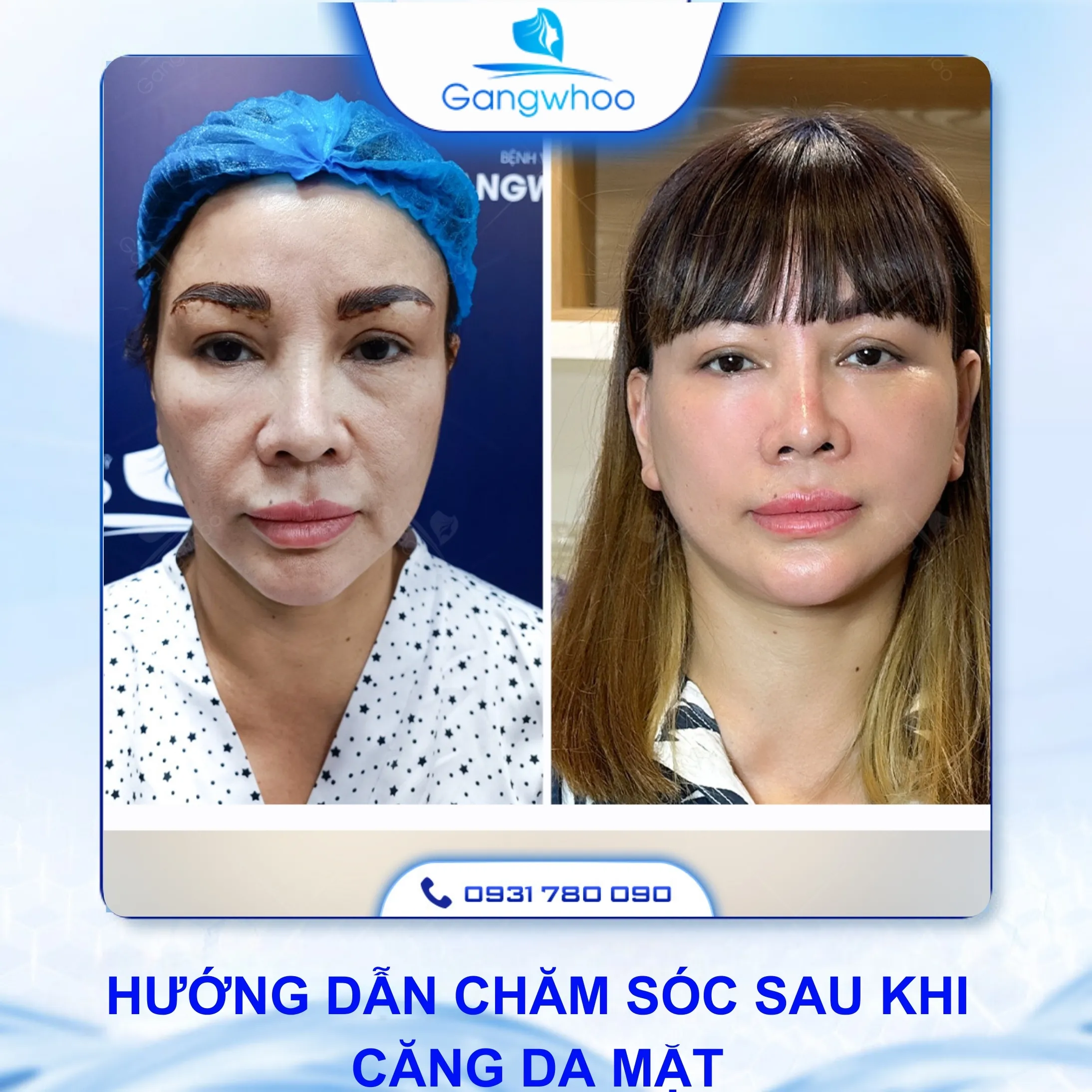 Căng Da Mặt Duy Trì Được Bao Lâu?