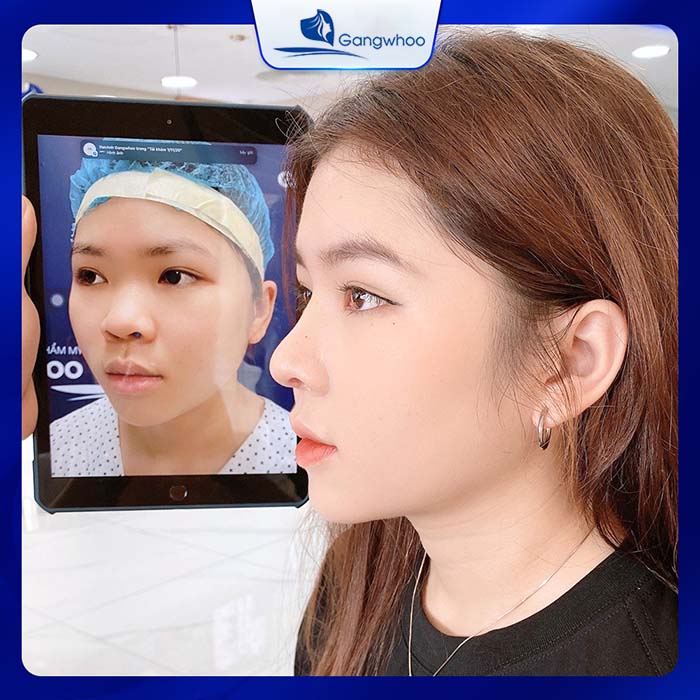 Nâng mũi bọc sụn là phương pháp nâng mũi được nhiều người ưu ái lựa chọn