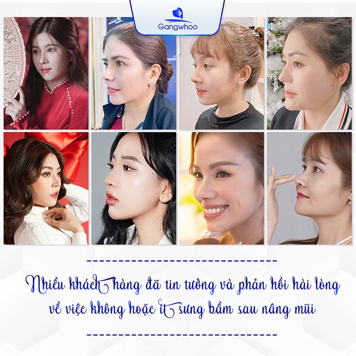 TMV Gangwhoo thực hiện thành công hơn hàng nghìn ca nâng mũi mỗi năm.