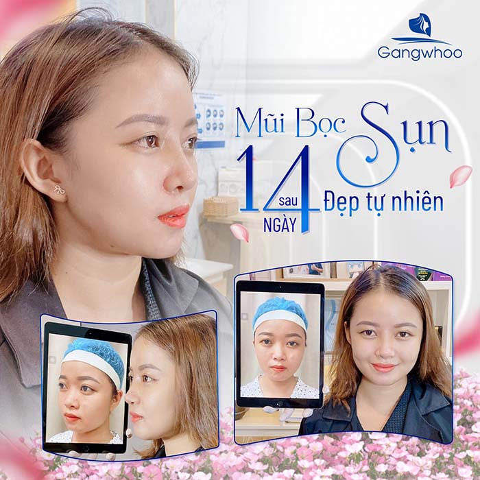 Có Nên Nâng Mũi Bọc Sụn Không? 3 Ý Không Thể Bỏ Qua