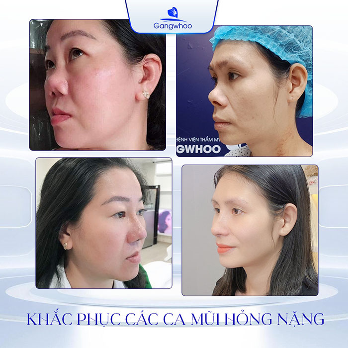TMV Gangwhoo khắc phục thành công các ca mũi hỏng nặng