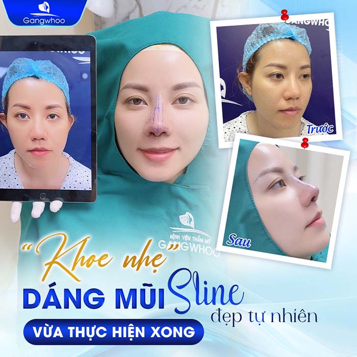 Gangwhoo sử dụng công nghệ tia Plasma lạnh, giúp giảm sưng bầm đáng kể sau nâng mũi