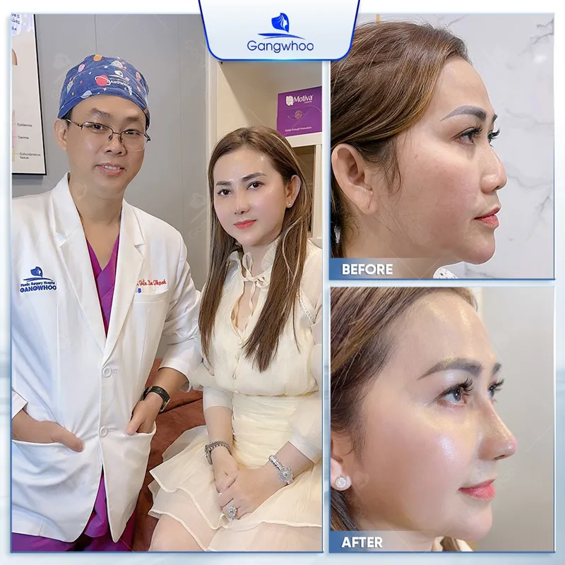 Nâng mũi đẹp, an toàn với TMV Gangwhoo