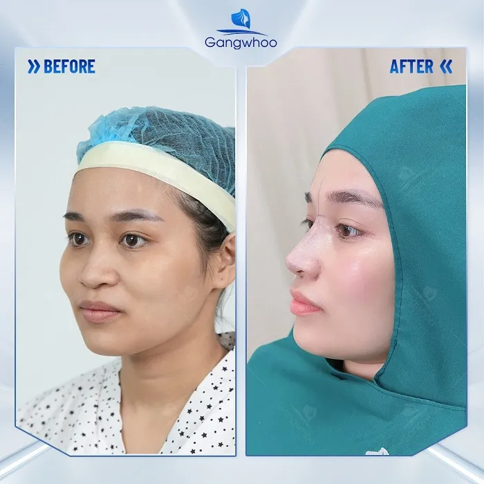 Cách chăm sóc sau nâng mũi cấu trúc để mũi hồi phục và đẹp nhanh chóng