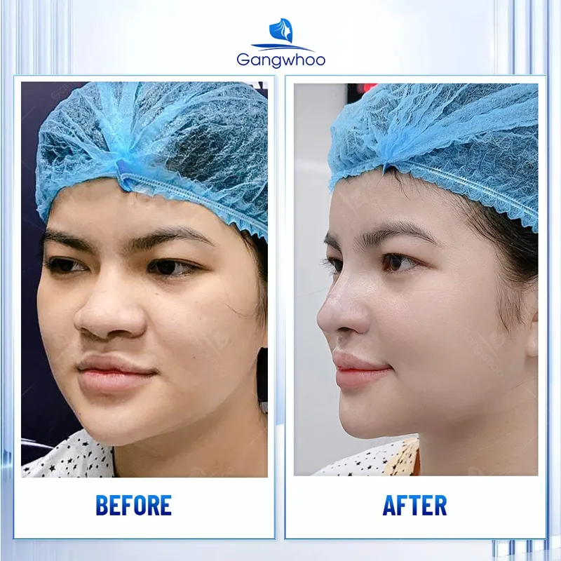 Tùy vào cơ địa mỗi người thời gian dáng mũi đẹp sẽ khác nhau