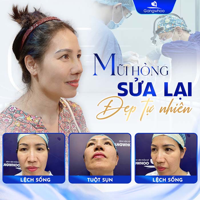 Tháo sụn mũi sẽ làm cho mũi của bạn trở nên bị “xuống cấp”, vì vậy bạn nên tái nâng mũi