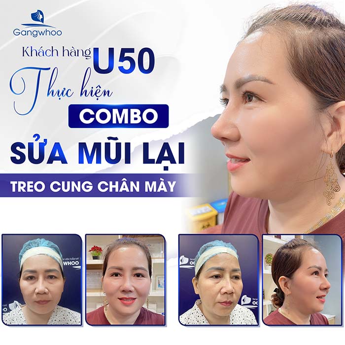 TMV Gangwhoo lấy lại sự tự tin cho khách hàng với combo tái phẫu thuật mũi hỏng và treo cung chân mày