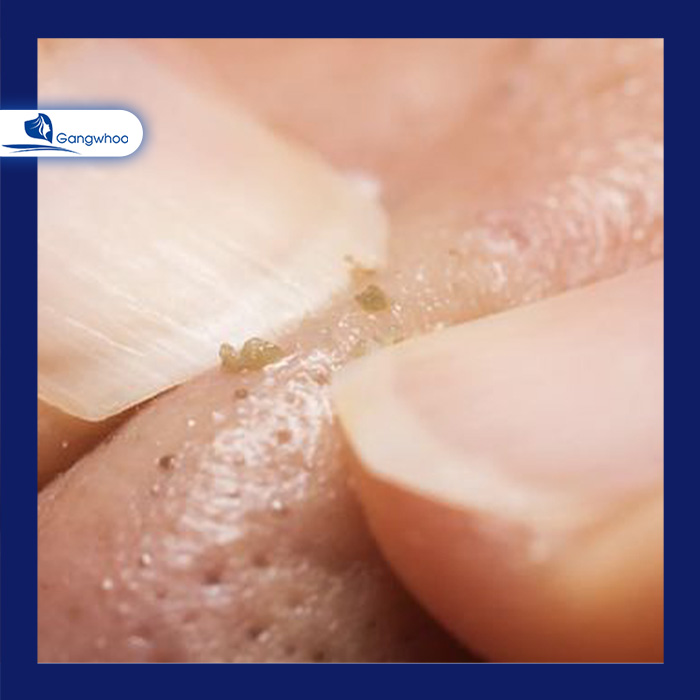 Tuyệt đối không tự ý dùng tay nặn mụn