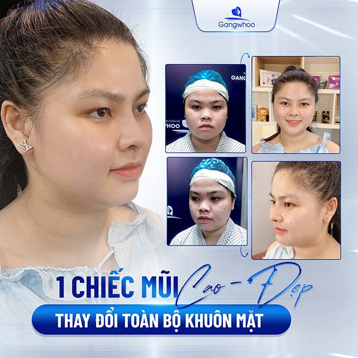 "Lột xác" ngoạn mục với dáng mũi cao đẹp chuẩn tỷ lệ