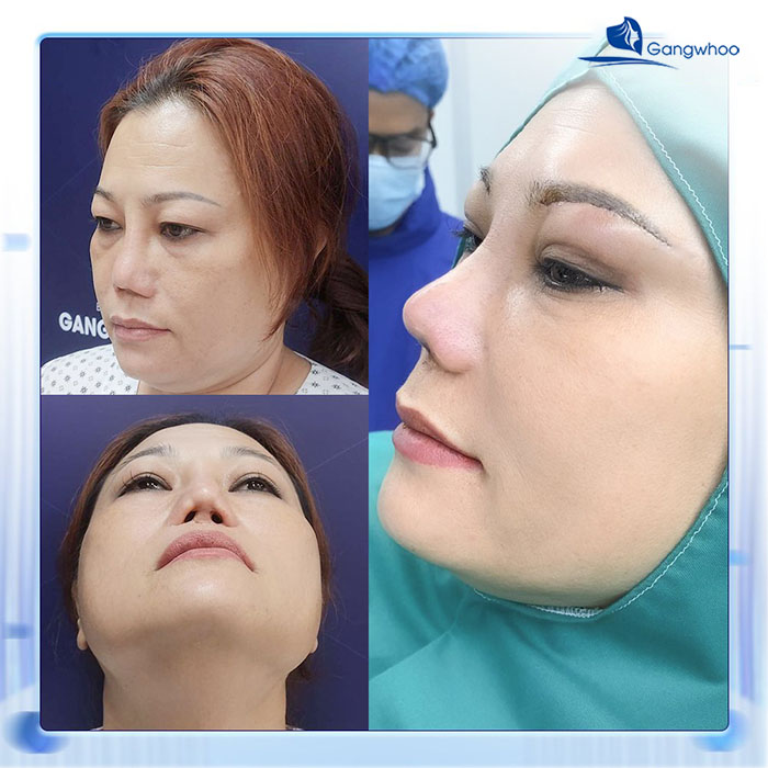 TMV Gangwhoo khắc phục mũi hỏng an toàn & hiệu quả