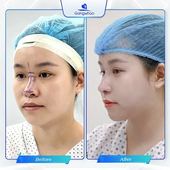 Hướng dẫn chăm sóc sau nâng mũi duy trì dáng mũi đẹp bền bỉ