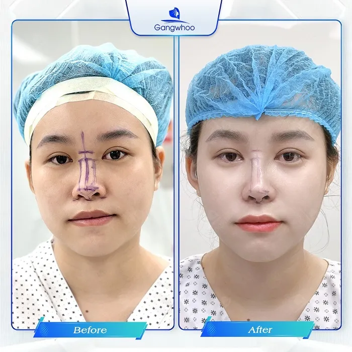 Khắc phục khuyết điểm mũi mang đến dáng mũi ưng ý