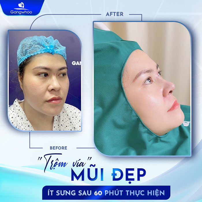 Mũi đẹp chỉ sau 60 phút nâng