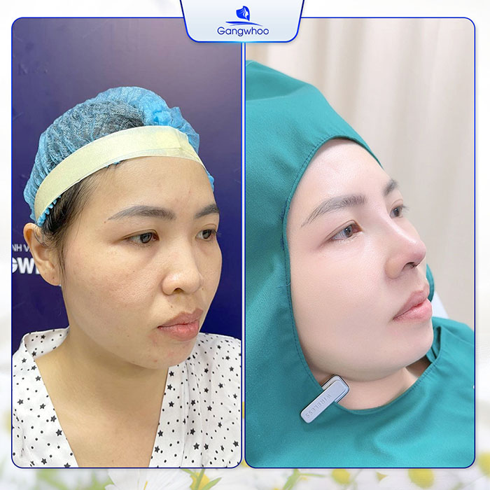 Nâng mũi cấu trúc có vĩnh viễn không? Có được bảo hành trọn đời không? Tìm Hiểu Ngay!