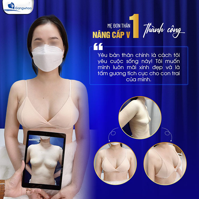 Thay đổi cuộc đời sau khi nâng ngực tại TMV Gangwhoo