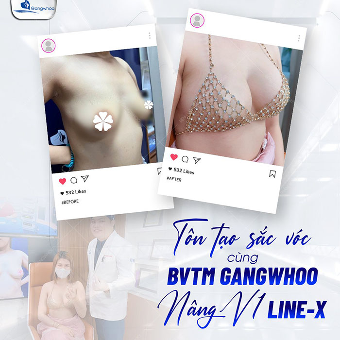 Ngực đẹp "chuẩn tỷ lệ vàng" 