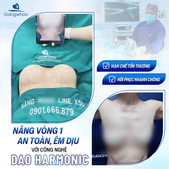 Thực hiện phẫu thuật nâng ngực Line X