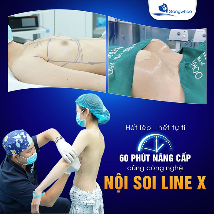 Nâng ngực Line X là giải pháp tuyệt vời cho chị em đang mong muốn sở hữu vóc dáng quyến rũ