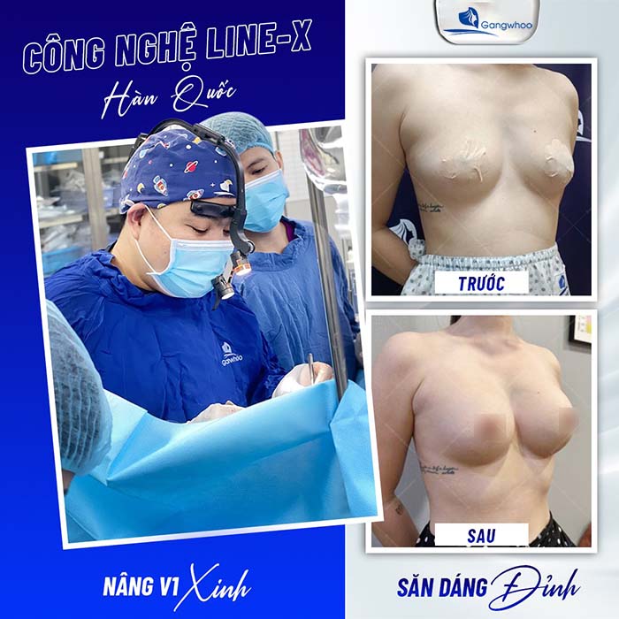 Nâng ngực Line X - Công nghệ nâng ngực được chuyển giao tại TMV Gangwhoo được chuyển giao trực tiếp từ Hàn Quốc