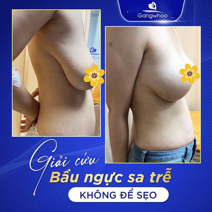 Treo sa trễ ngực AN TOÀN & HIỆU QUẢ tại TMV Gangwhoo