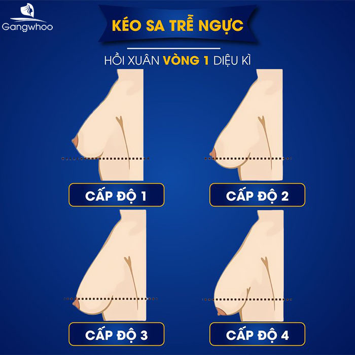 Tìm hiểu 4 cấp độ sa trễ ngực