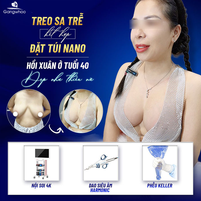 Treo sa trễ bằng cách đặt túi được nhiều bác sĩ chuyên môn khuyên dùng