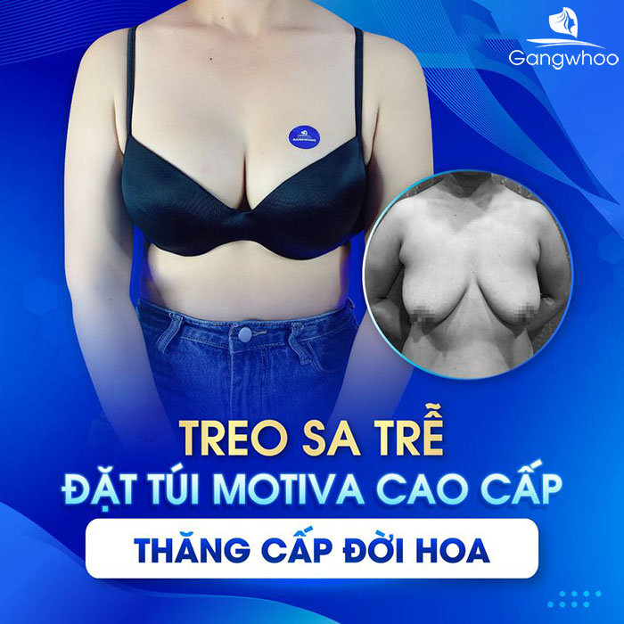 Người bị phì đại, sa trễ bẩm sinh, lâu năm không nên bỏ qua phương pháp treo sa trễ ngực
