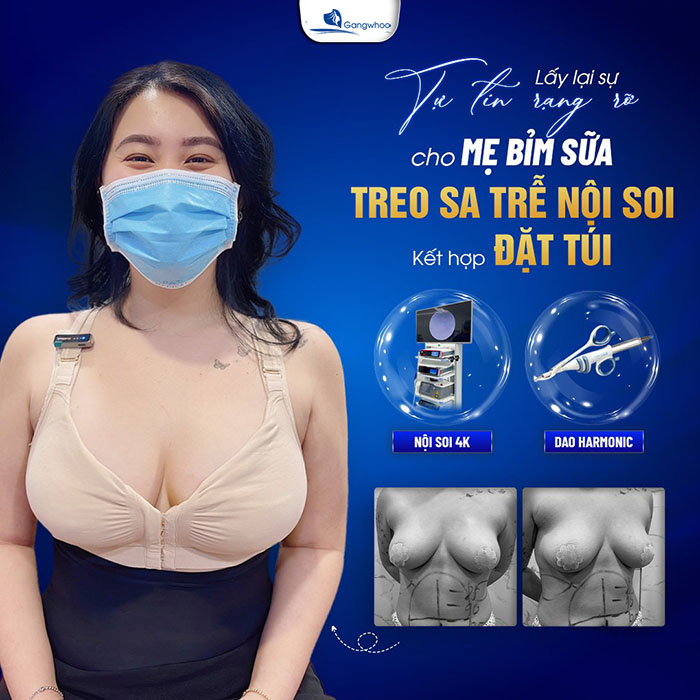 Treo sa trễ là một phương pháp thẩm mỹ có độ an toàn cao, ít xâm lấn và không để lại sẹo xấu. 