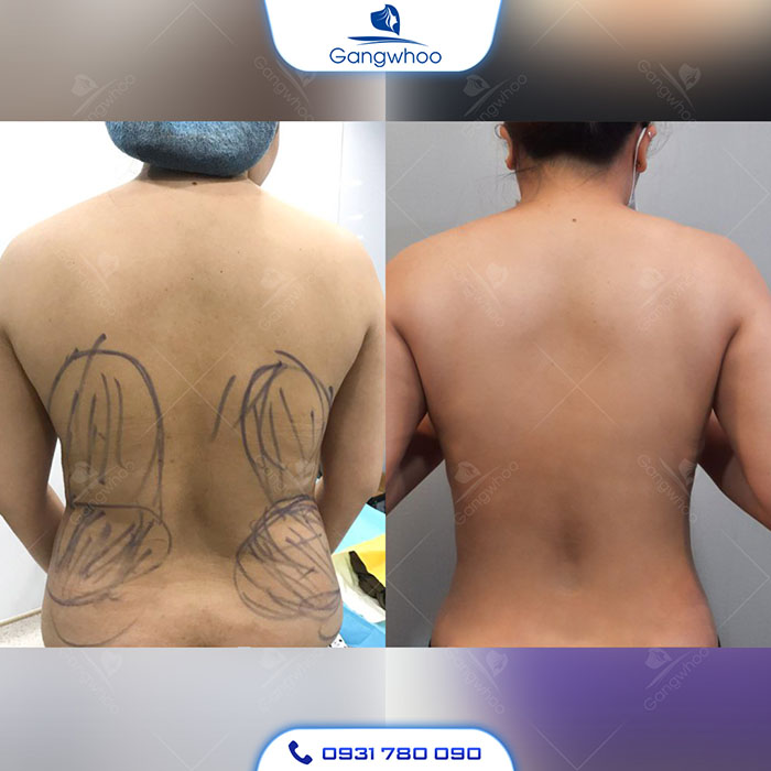 Hút mỡ lưng tại TMV Gangwhoo loại bỏ 98% mỡ thừa