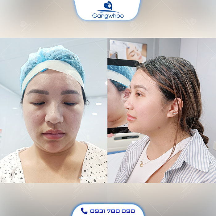 Khuôn mặt đẹp sắc nét sau khi hút mỡ nọng cằm