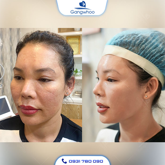 Đẹp toàn diện với combo hút mỡ nọng cằm kết hợp với căng da mặt 