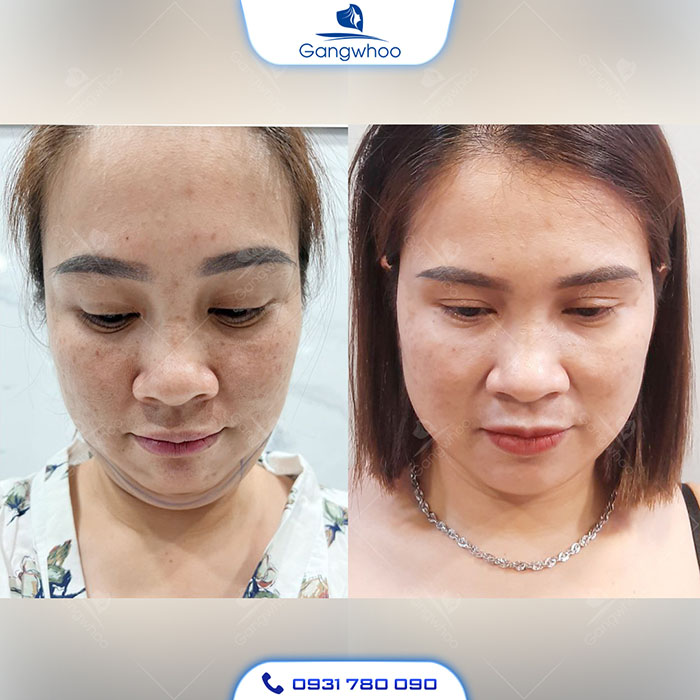 Lipo Ultrasound là phương pháp hút mỡ nọng cằm an toàn, hiệu quả