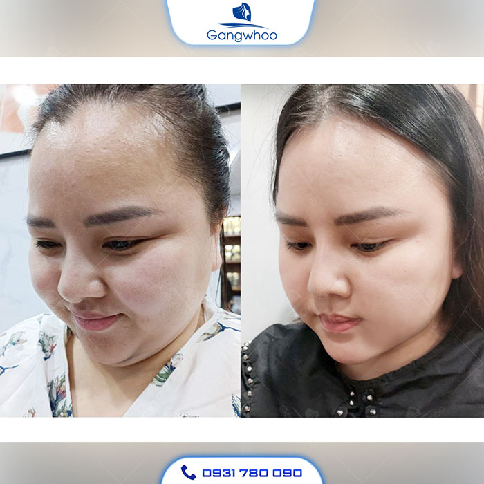 Tích hợp 5 ưu thế trong 1 công nghệ: “Không xâm lấn – Không phẫu thuật – Không ăn kiêng – Không sẹo xấu – Không tích mỡ trở lại”.