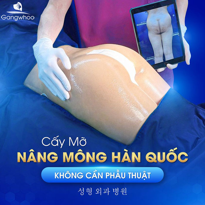 Cấy mỡ nâng mông là sự lựa chọn được rất nhiều chị em quan tâm