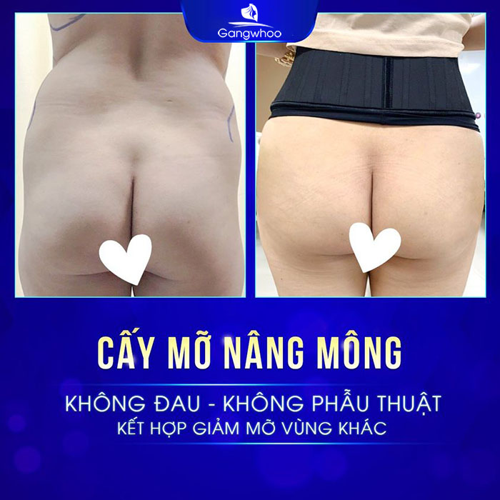 Hình dáng, thể tích của mông được cải thiện một cách rõ rệt