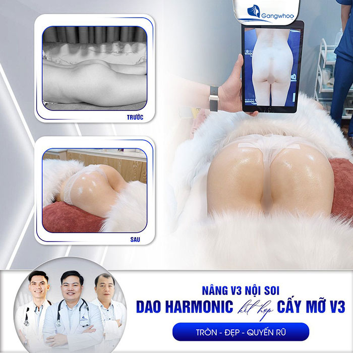 Sở hữu vòng 3 tròn - đẹp - quyến rũ nhanh chóng với nâng mông nội soi