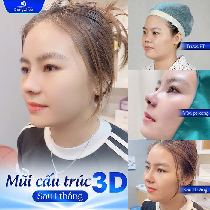 Nâng mũi câu trúc có độ can thiệp sâu, tuy nhiên hiệu quả thẩm mỹ mang lại được tối ưu