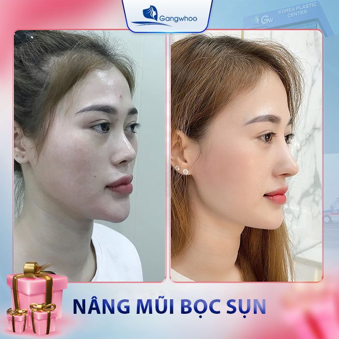 Nâng mũi bọc sụn giúp cho dáng mũi được cao thanh tú