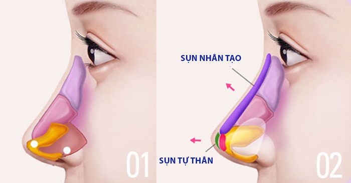 Nâng mũi bọc sụn giải quyết được khuyết điểm mũi lộ sóng, bóng đỏ đầu mũi sau nâng