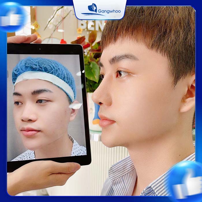 Mũi đẹp "chuẩn men" sau khi nâng mũi tại TMV Gangwhoo