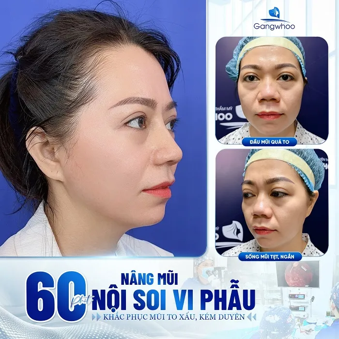 Quá trình nâng mũi được thực hiện bởi hệ thống công nghệ hiện đại