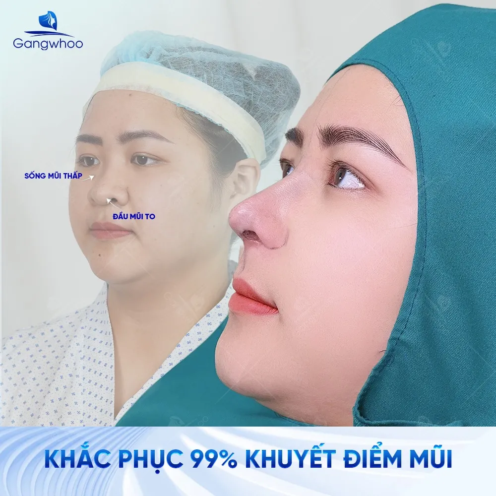 TMV Gangwhoo - Địa chỉ nâng mũi đẹp, an toàn tại TP.HCM 