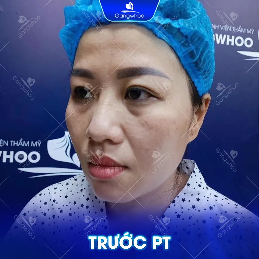 Đối tượng nên thực hiện nâng mũi sụn tai sinh học