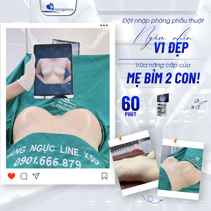 Nâng ngực an toàn, kết quả chất lượng tại Gangwhoo 