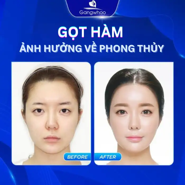 Gọt Hàm Có Ảnh Hưởng Về Sau Không? Bao Lâu Thì Lành?