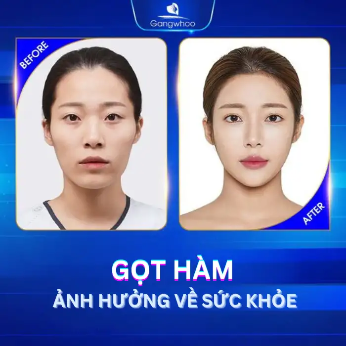Gọt Hàm Có Ảnh Hưởng Về Sau Không? Bao Lâu Thì Lành?