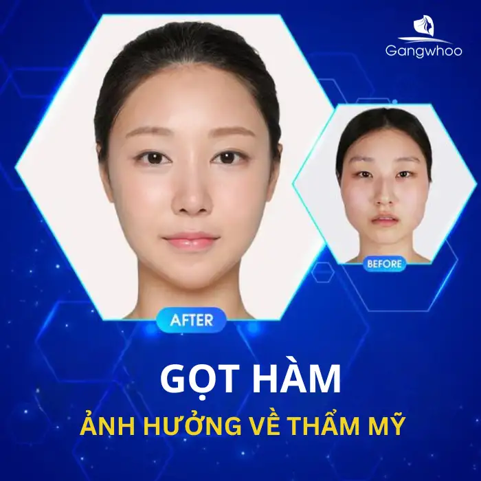 Gọt Hàm Có Ảnh Hưởng Về Sau Không? Bao Lâu Thì Lành?