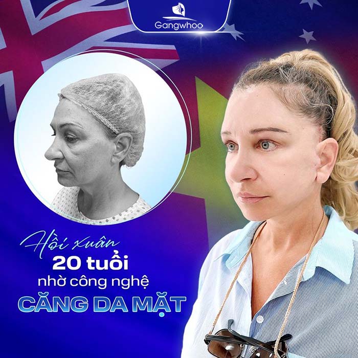 "Cải lão hoàn đồng" sau khi căng da mặt tại TMV Gangwhoo