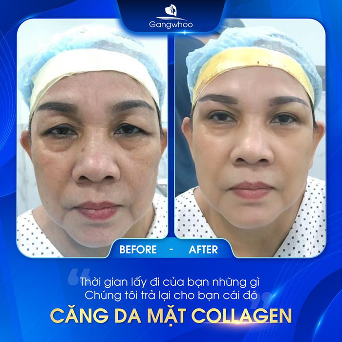 Căng Da Mặt Trẻ Hóa Bằng Chỉ Firin Nano Collagen mang đến nhiều ưu điểm vượt trội